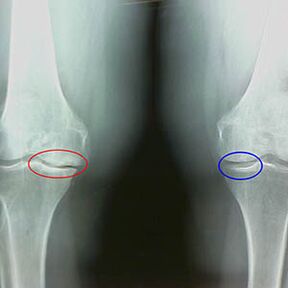 A térdízület arthrosis a röntgenfelvételen