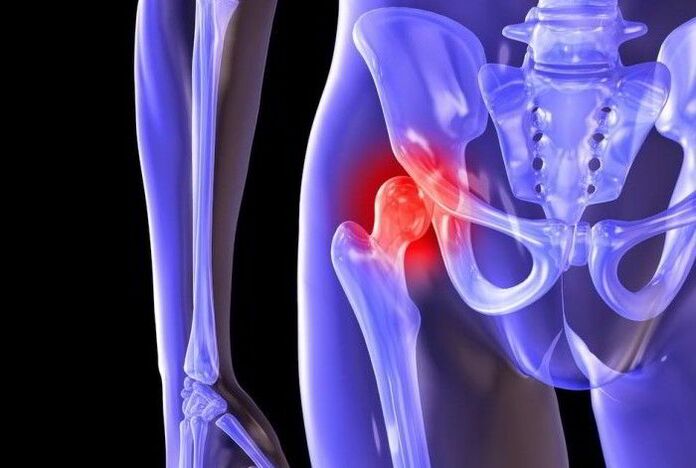 Patológiás folyamat a csípőízületben coxarthrosisban